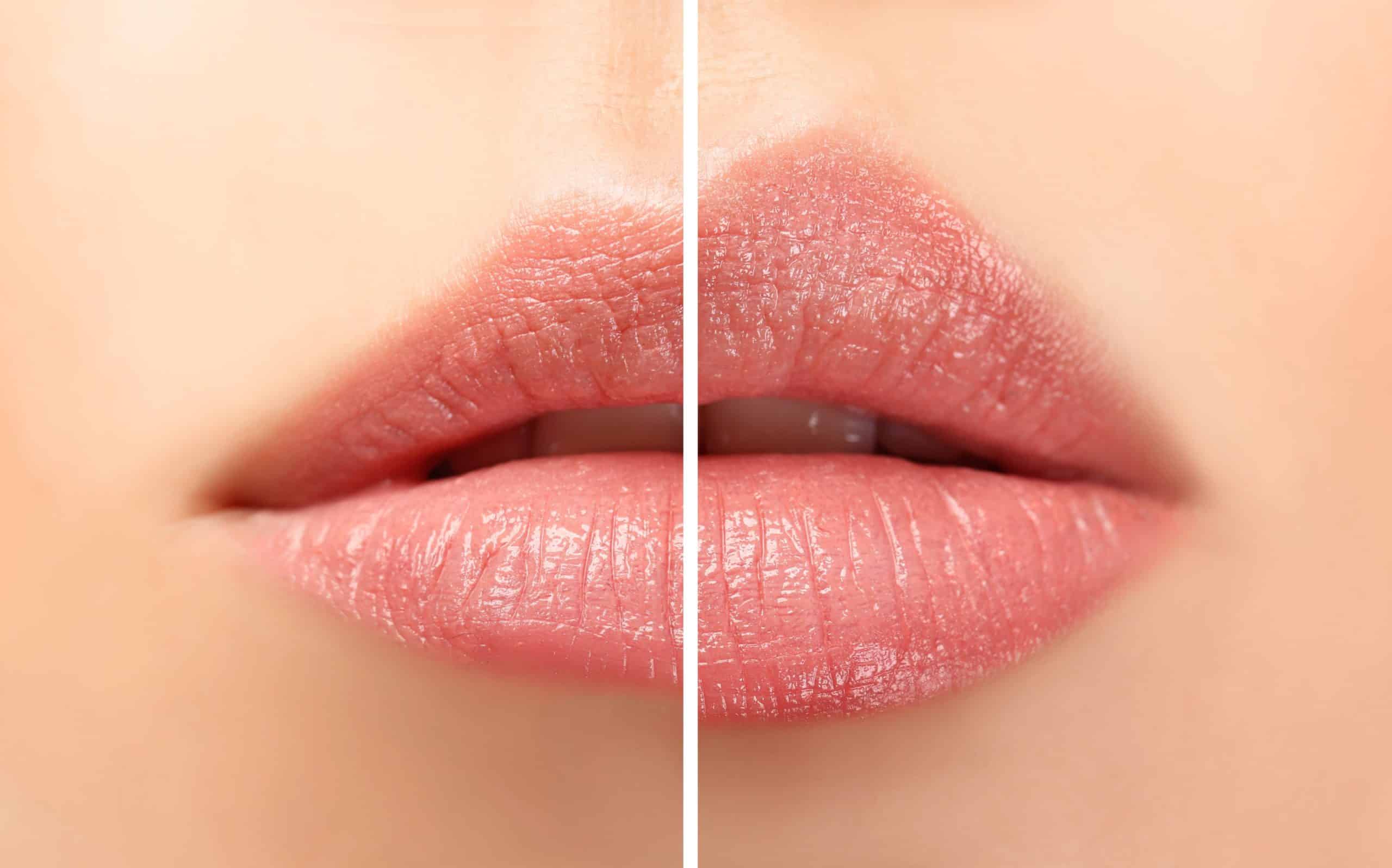 Before and After Lip Filler Treatment result of Female | La Lumiere Esthetique in Dallas, TX